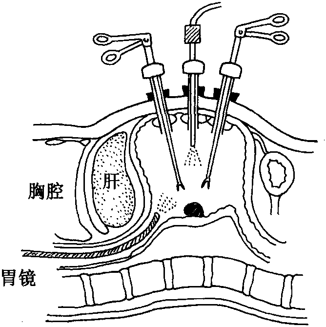 四、腹腔鏡下胃癌切除術(shù)
